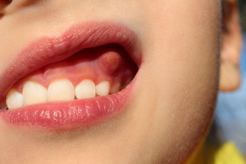 Sâu răng gây viêm họng có nguy hiểm không? 1