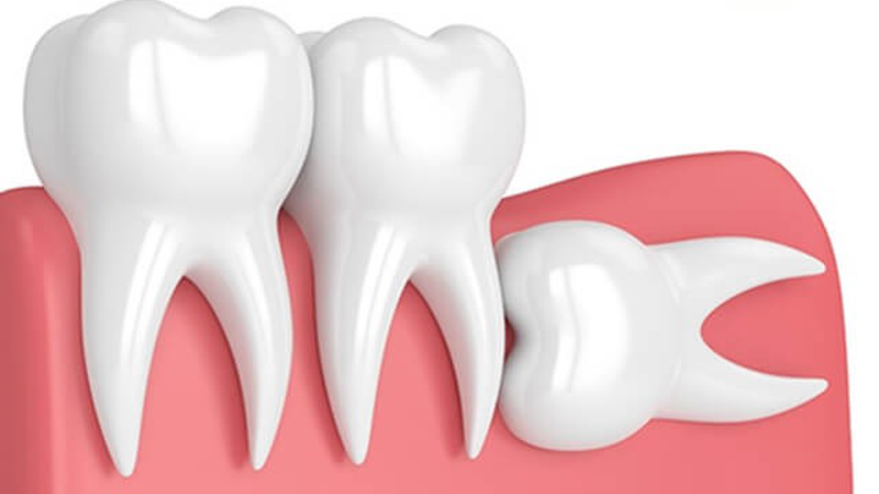 Sâu răng gây viêm họng có nguy hiểm không? 2