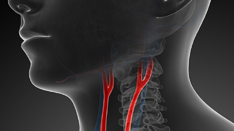 Siêu âm động mạch cảnh 2