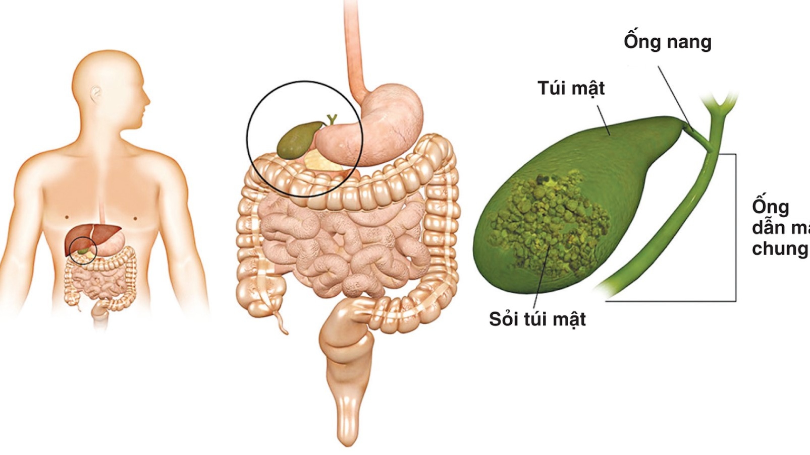 Sốc nhiễm trùng đường mật và những thông tin cần biết