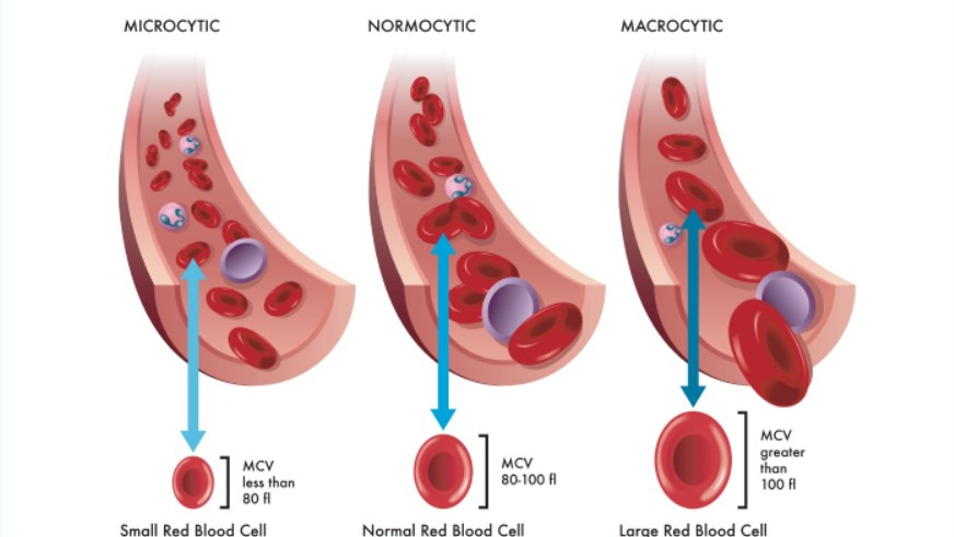Ý nghĩa của chỉ số thể tích trung bình hồng cầu trong xét nghiệm máu