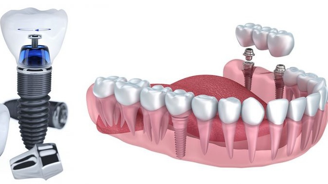 Tìm hiểu về trồng răng implant nguyên hàm