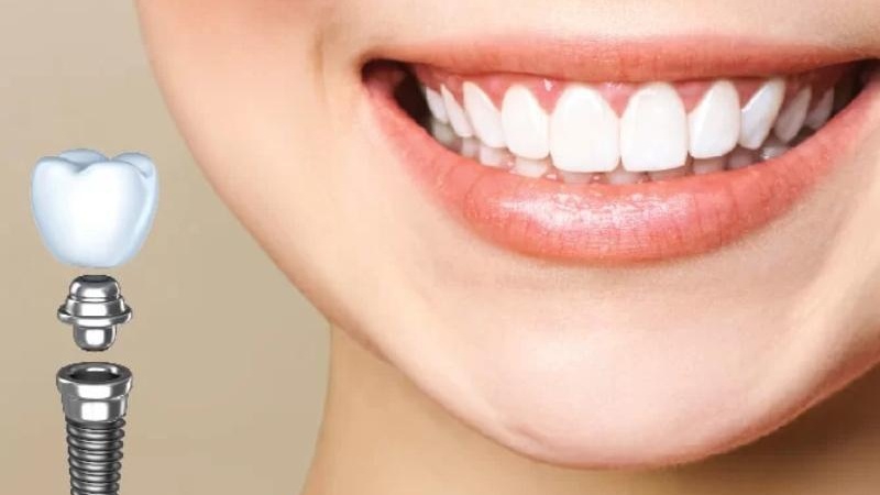 Trồng răng implant nguyên hàm 01