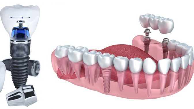 Trồng răng implant nguyên hàm 02