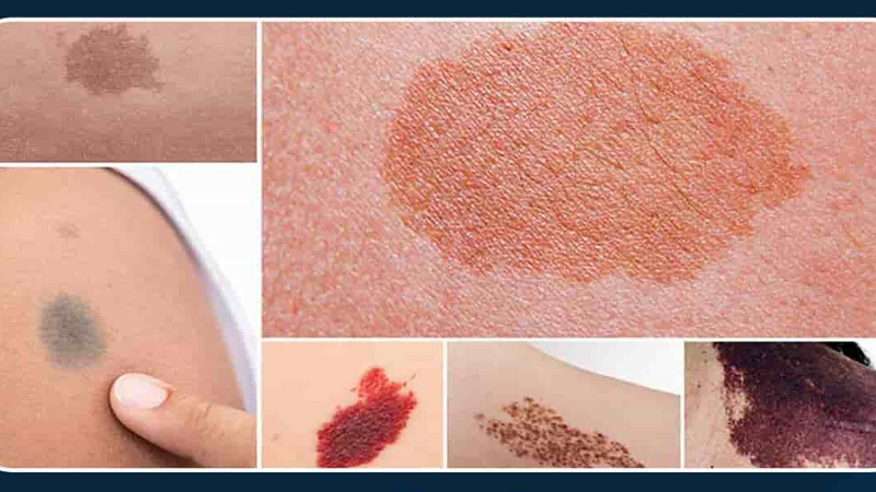 Tình trạng bớt sắc tố ở da: Phân loại, nguyên nhân và cách điều trị 1