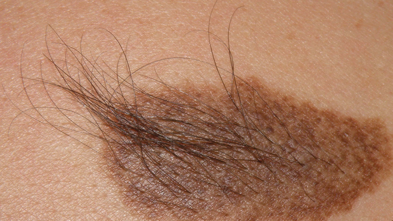 Tình trạng bớt sắc tố ở da: Phân loại, nguyên nhân và cách điều trị 3