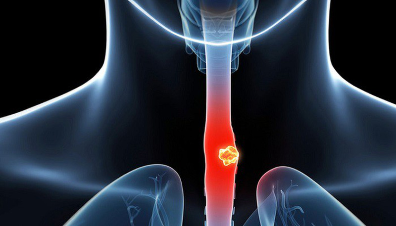 Ung thư thực quản di căn xương: Dấu hiệu, nguyên nhân và cách điều trị 1
