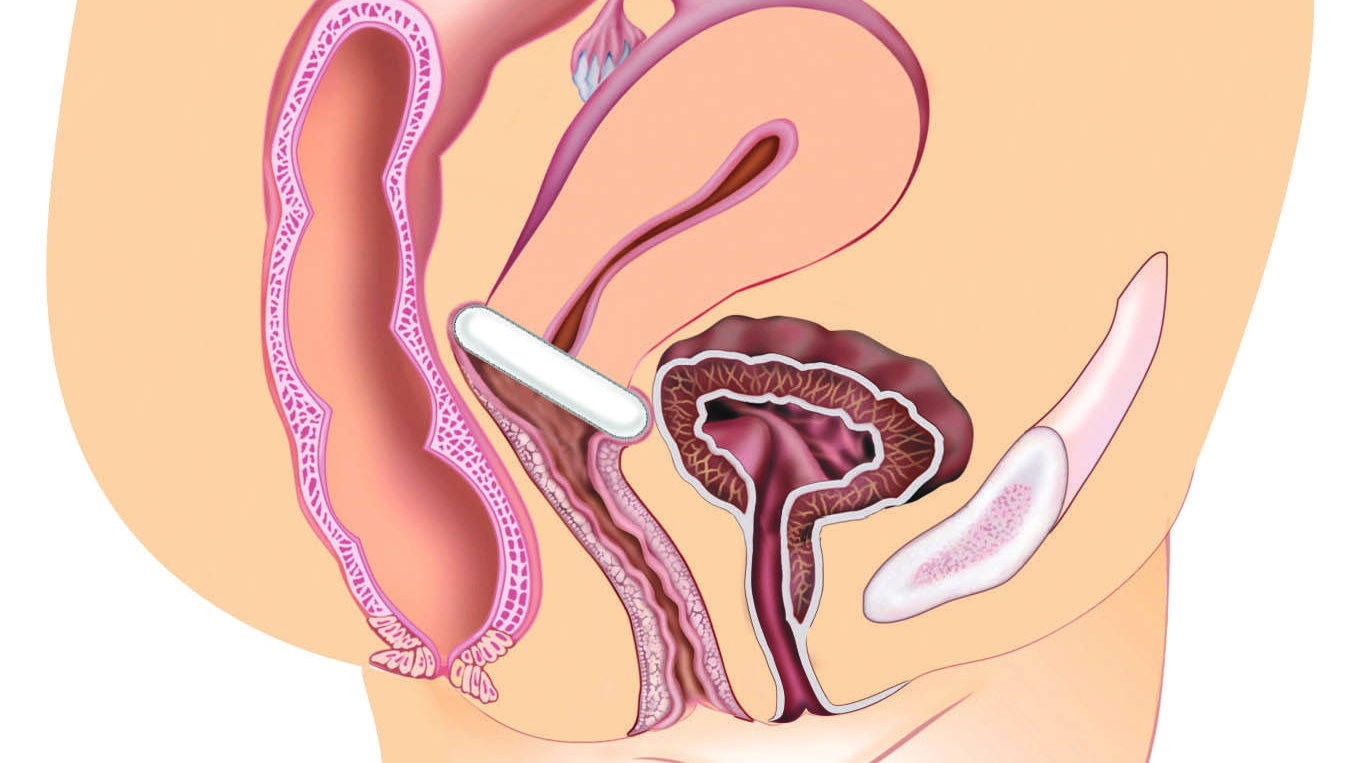 Vòng nâng pessary trong điều trị bệnh sa tạng vùng chậu