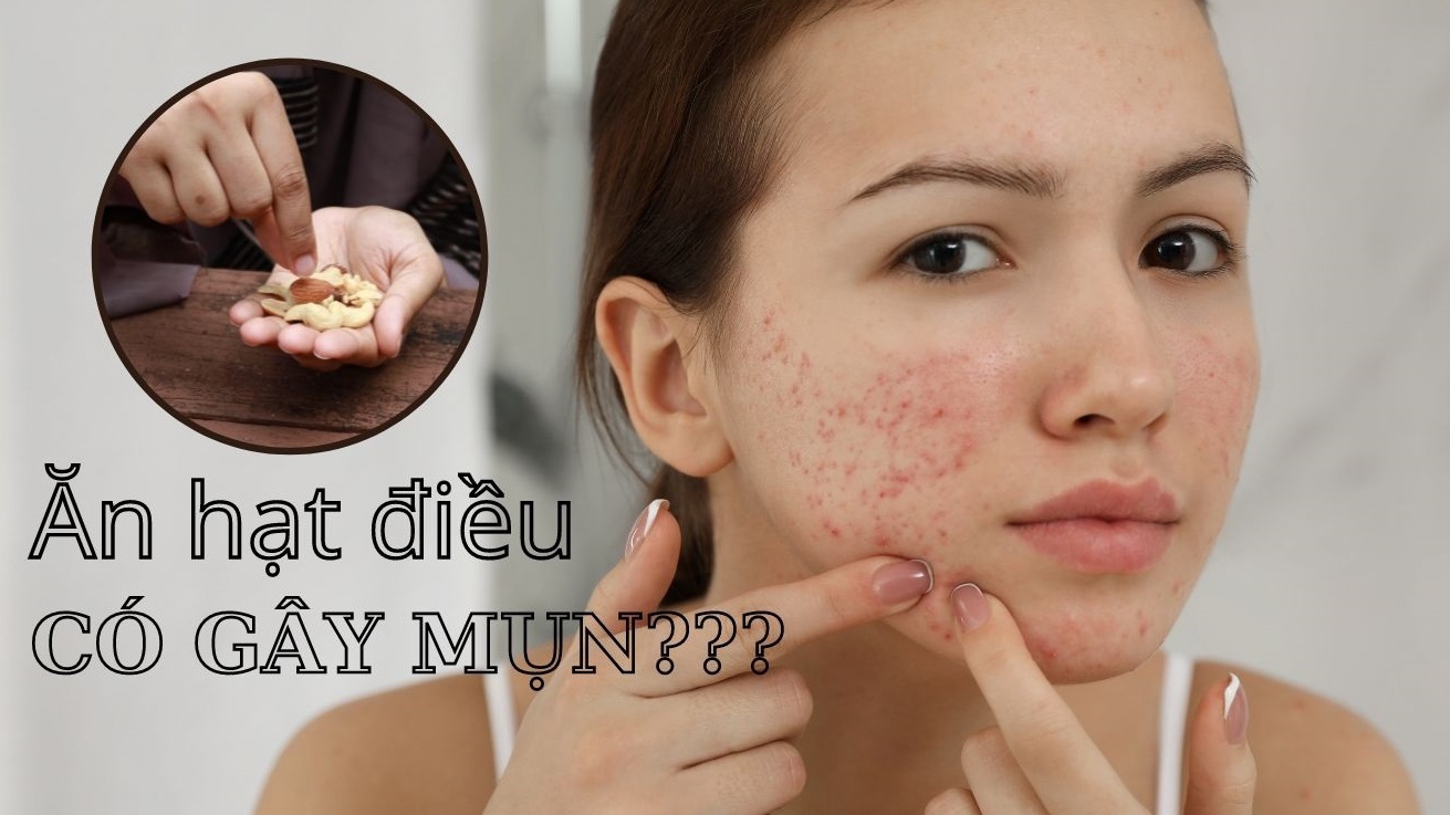 Ăn hạt điều có nổi mụn không?