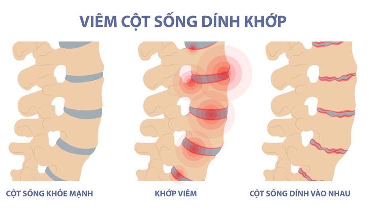 Biến chứng của viêm cột sống dính khớp và cách điều trị