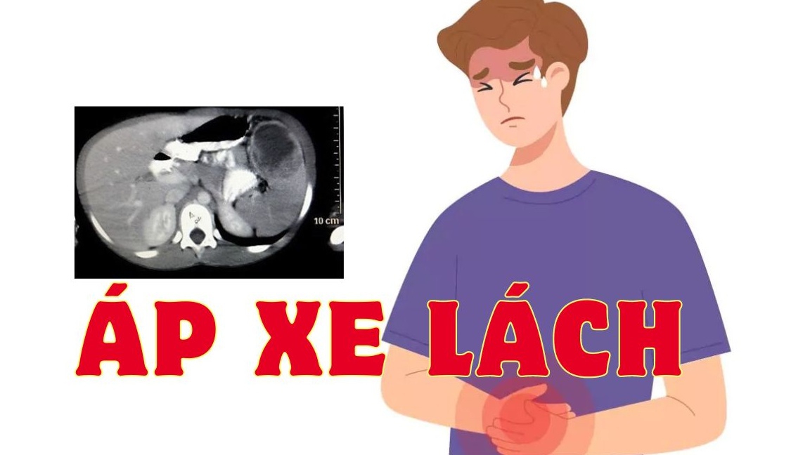 Áp xe lách có nguy hiểm không? Điều trị thế nào?