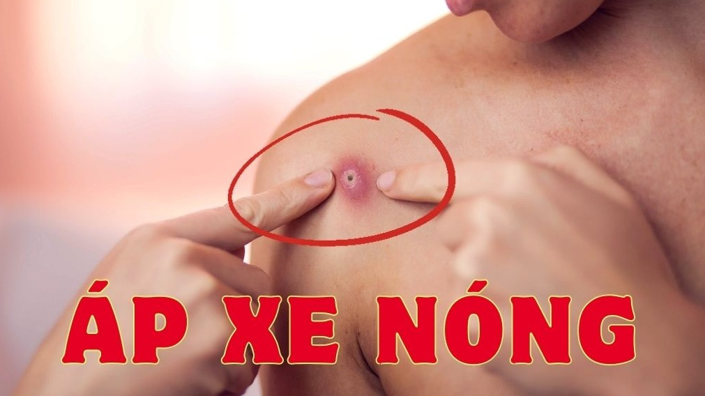 Áp xe nóng là gì? Nguyên nhân, triệu chứng và cách điều trị hiệu quả