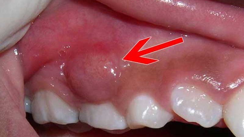 Áp xe nướu răng: Nguyên nhân, triệu chứng, biến chứng, cách phòng ngừa và chữa trị 1