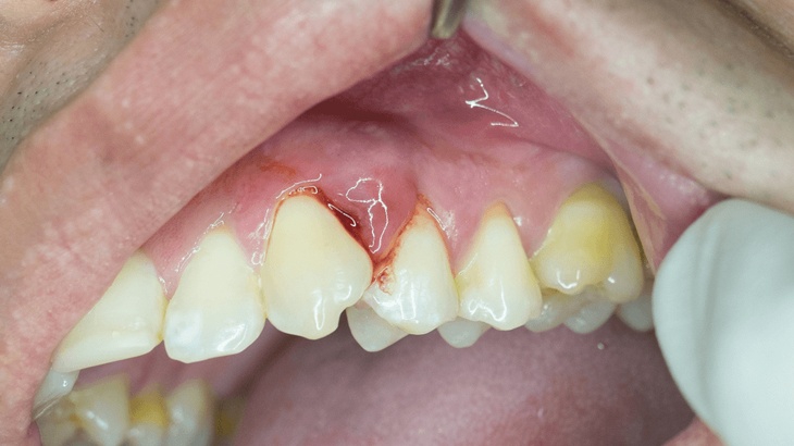 Áp xe nướu răng: Nguyên nhân, triệu chứng, biến chứng, cách phòng ngừa và chữa trị