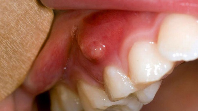 Triệu chứng và cách điều trị áp xe quanh chóp răng 1