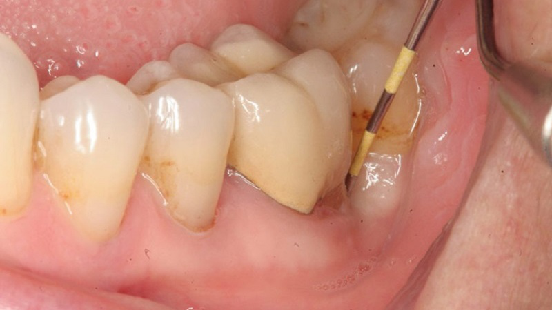 Triệu chứng và cách điều trị áp xe quanh chóp răng 2