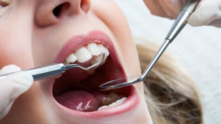 Triệu chứng và cách điều trị áp xe quanh chóp răng 3
