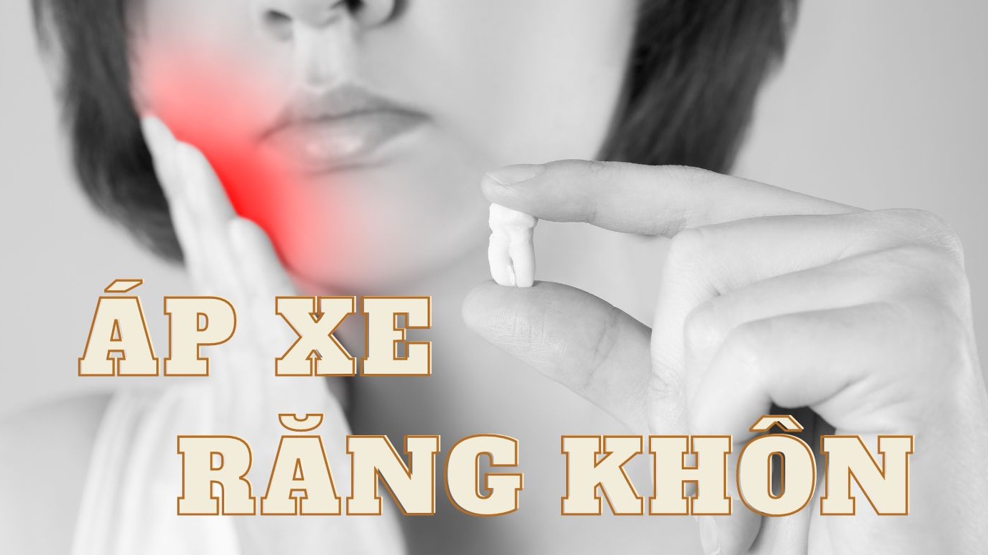 Áp xe răng khôn nguy hiểm thế nào? Chữa trị ra sao?