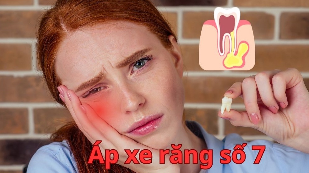 Áp xe răng số 7 có nguy hiểm không? Triệu chứng và cách điều trị