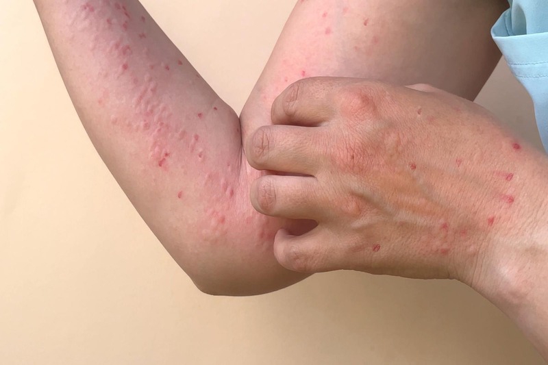 Aplastic anemia là gì? Những biến chứng thường gặp 3