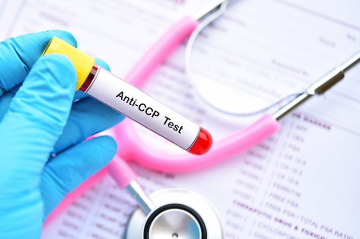 Anti CCP: Xét nghiệm hỗ trợ chẩn đoán viêm khớp dạng thấp 2