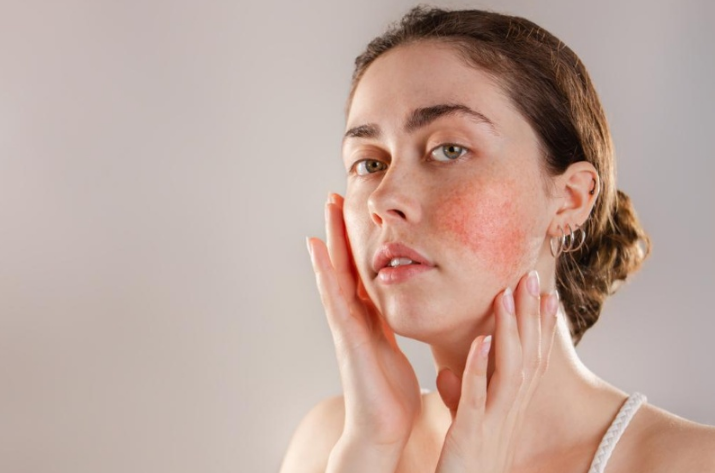 Điều trị chàm bằng laser toning và những điều cần biết 2