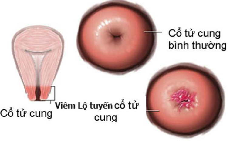 Thắc mắc: Đốt viêm lộ tuyến kiêng gì? 1