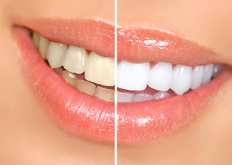 Gel làm trắng răng có thực sự tốt không? Những lưu ý khi sử dụng  1