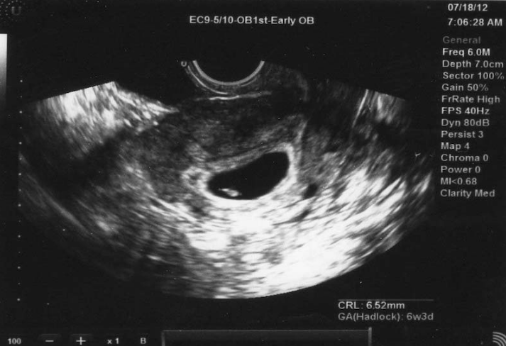 Khả năng quan sát thai nhi qua siêu âm ở tuần thứ 4