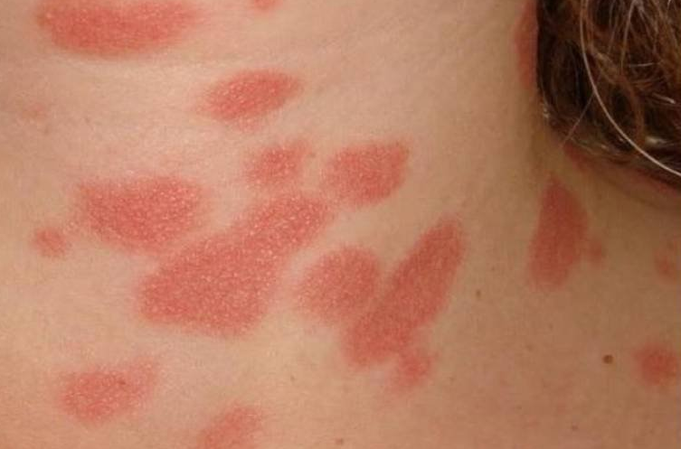 Hiện tượng bị nổi vòng tròn đỏ trên da là do bệnh lý? 1