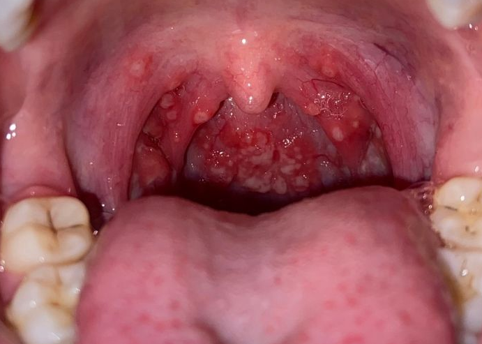 Nhiệt miệng trong cổ họng: Nguyên nhân, triệu chứng và cách xử trí 1