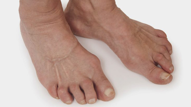 Nổi cục ở mu bàn chân có phải là dấu hiệu của bệnh ung thư hay không?

