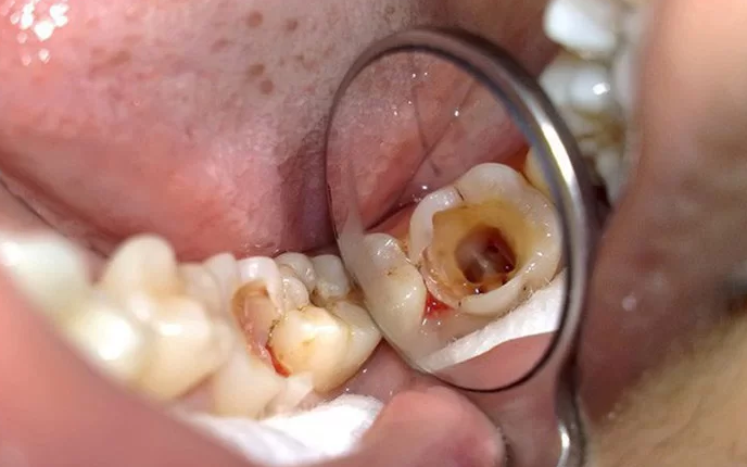 Quy trình nhổ răng hàm như thế nào? Cần lưu ý gì? 2