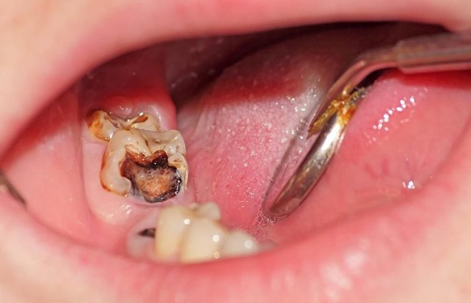 Quy trình nhổ răng hàm như thế nào? Cần lưu ý gì? 3