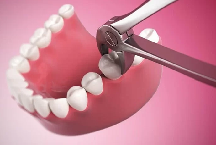 Quy trình nhổ răng hàm như thế nào? Cần lưu ý gì? 4