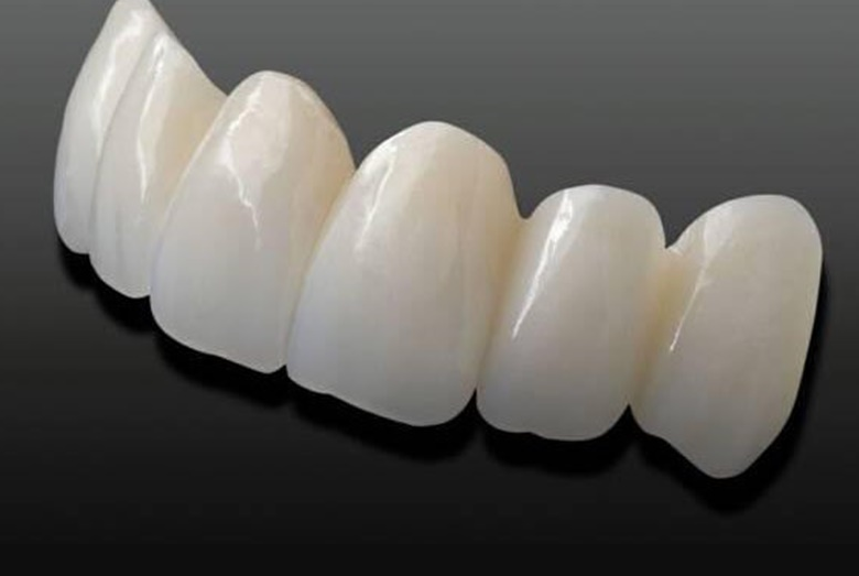 So sánh răng sứ Cercon với các loại răng sứ khác: Nên chọn loại nào?