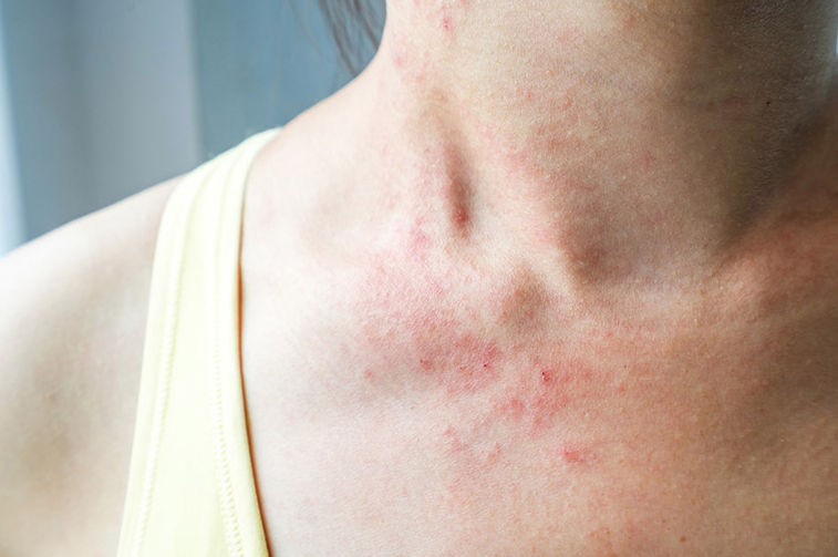 Tại sao một số người không ăn được cua ghẹ​? Làm sao khắc phục? 4