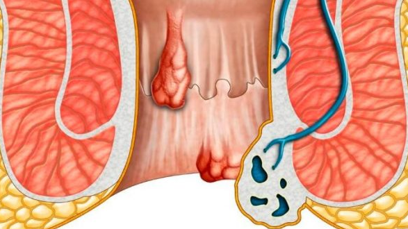 Làm thế nào để phát hiện và chẩn đoán tắc mạch trĩ?
