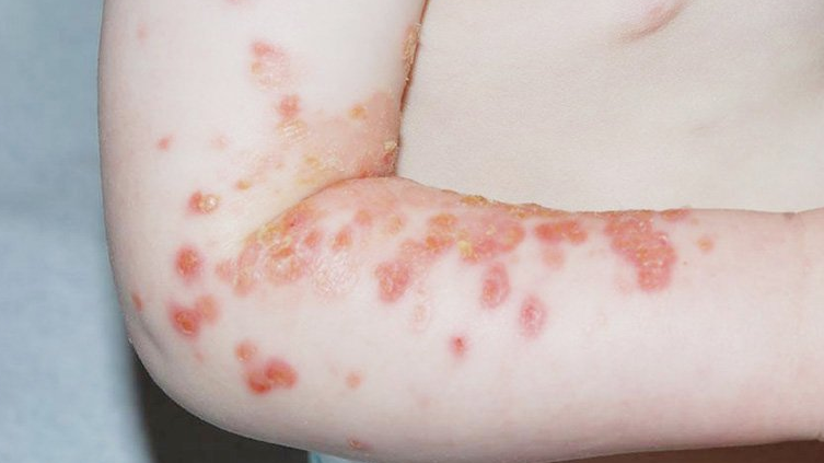 Viêm da mủ: Nguyên nhân gây bệnh và lưu ý khi điều trị