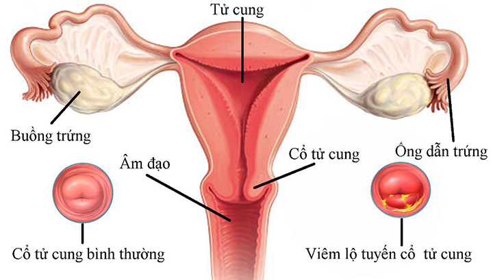 Viêm lộ tuyến có mấy cấp độ, do nguyên nhân nào?