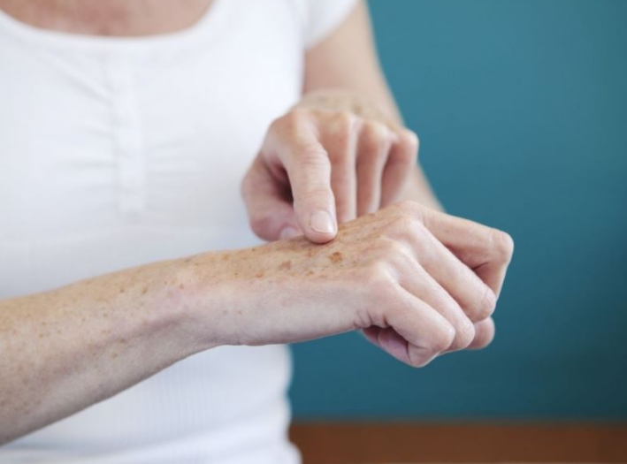 Xuất hiện vết thâm đen trên da tay do bệnh lý gì? Cách điều trị ra sao? 1