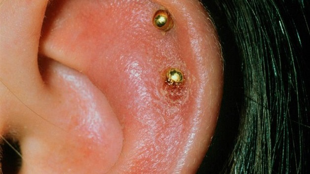 Bấm lỗ tai bị sưng mủ chảy máu, nguyên nhân và cách giải quyết?