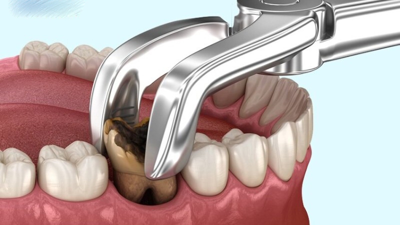 Bạn biết gì về răng số 6? 4