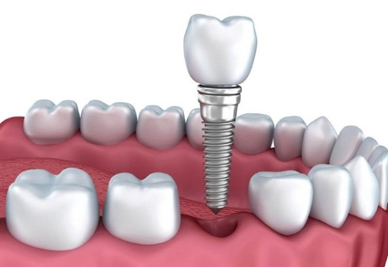 Bạn biết gì về răng số 6? 5