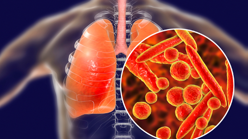 Khi nào cần phải cách ly người mắc bệnh lao phổi? 
