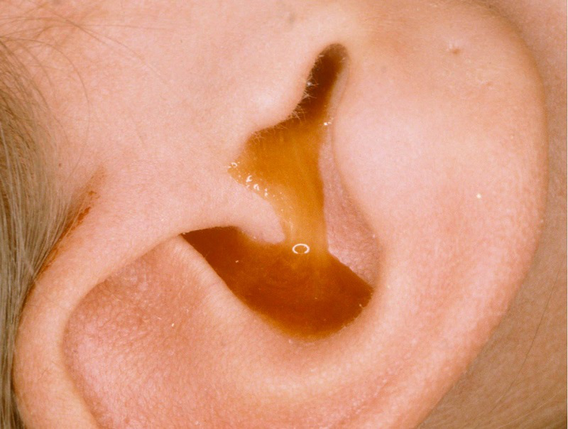 Bạn đã biết cách vệ sinh tai khi bị chảy mủ hiệu quả? 1