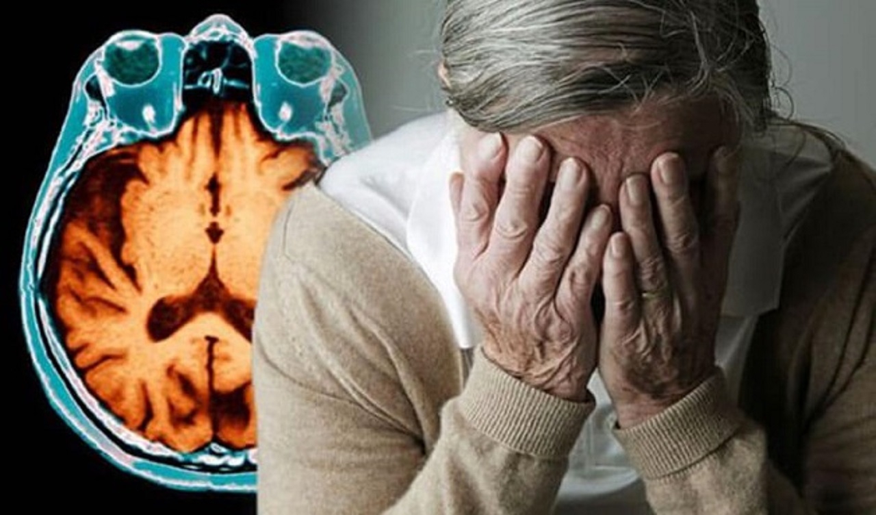 Bạn đã biết hết những biểu hiện của bệnh Alzheimer để phòng tránh hay chưa?