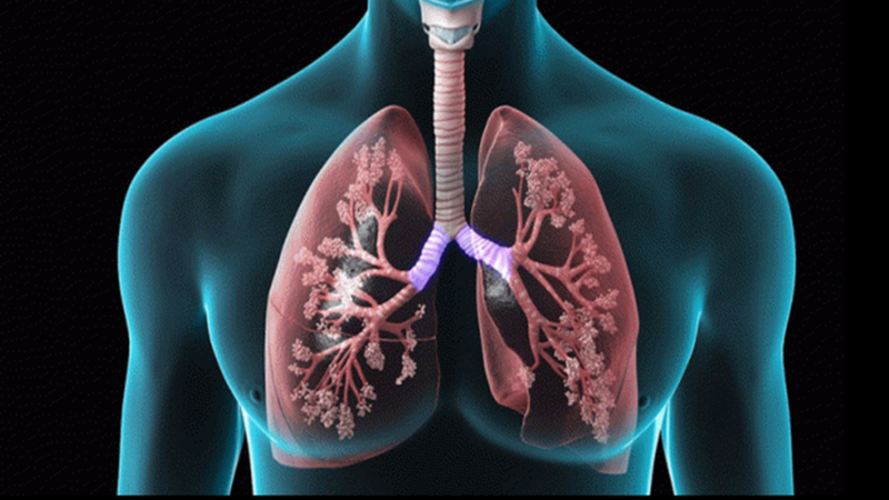 Các triệu chứng của bệnh xơ phổi là gì?
