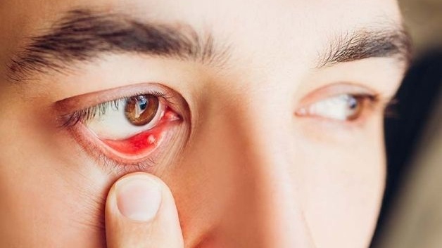 Có những cách điều trị chắp mắt nào khác ngoài phương pháp dân gian?
