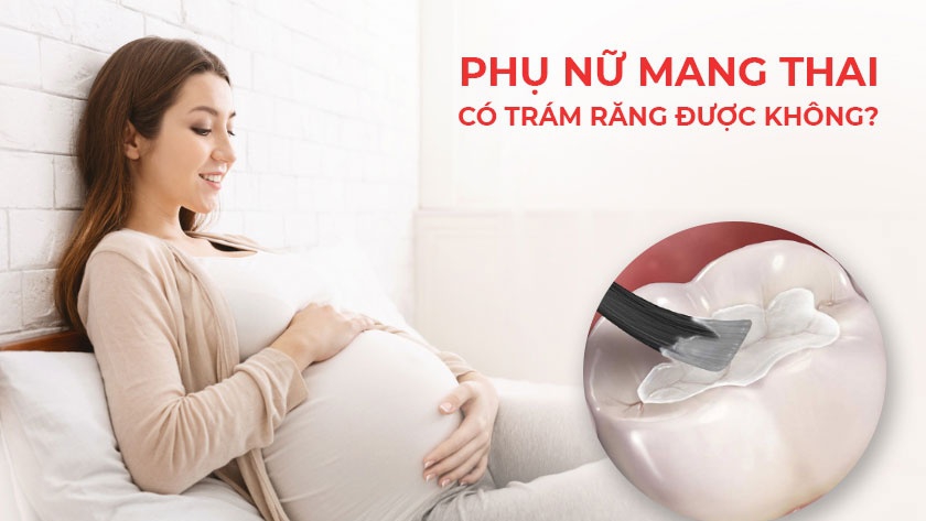 Bà bầu có trám răng được không? Có ảnh hưởng gì không?